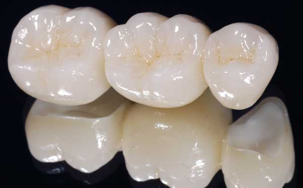 Fixed Partial Dentures(Bridges)